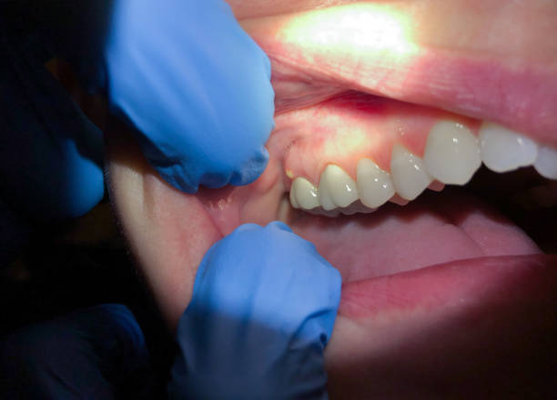 Best Emergency Root Canal Treatment in Rockwall, TX